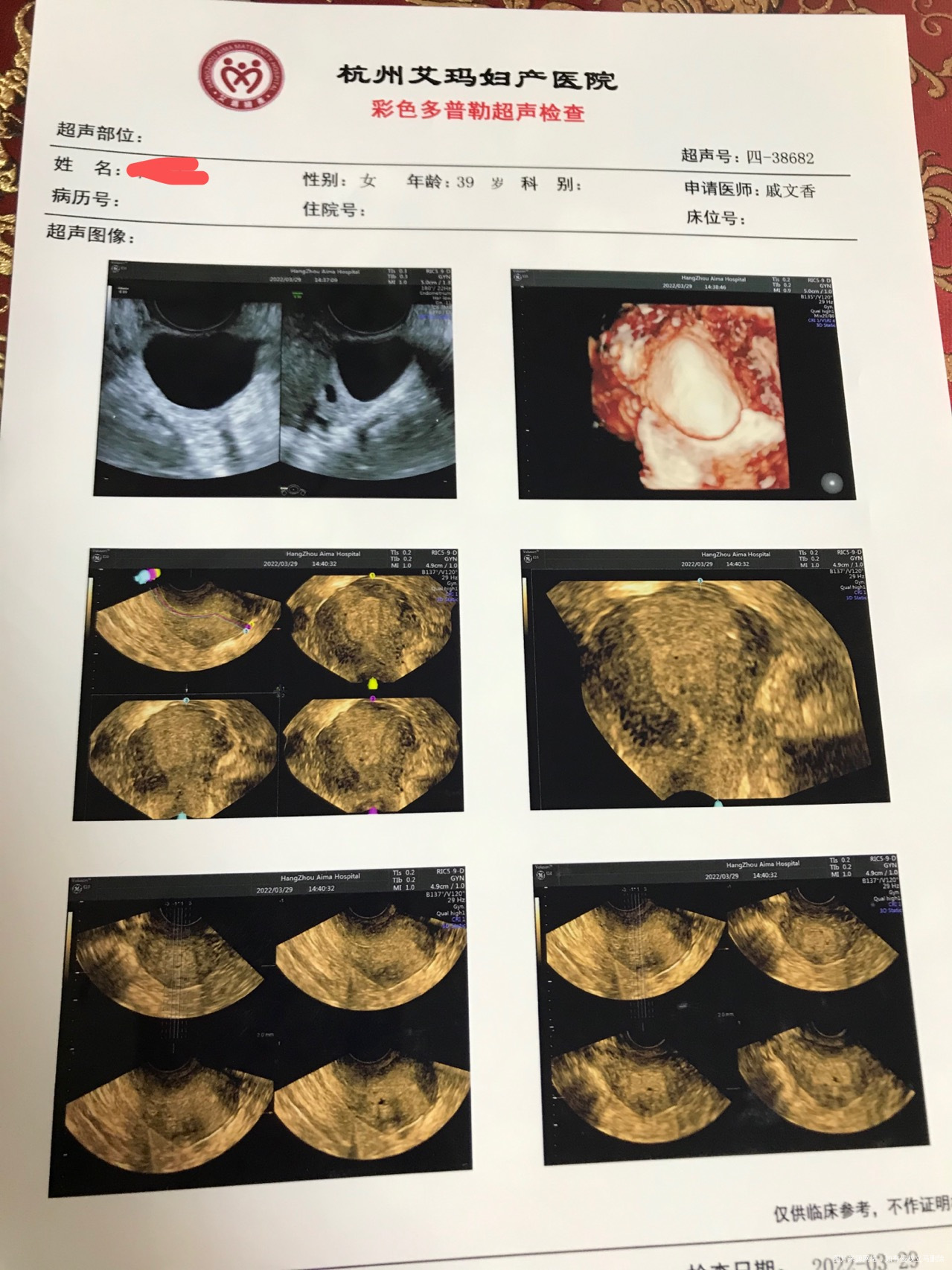 医生您好麻烦您帮我看下我18周+5引产后子宫