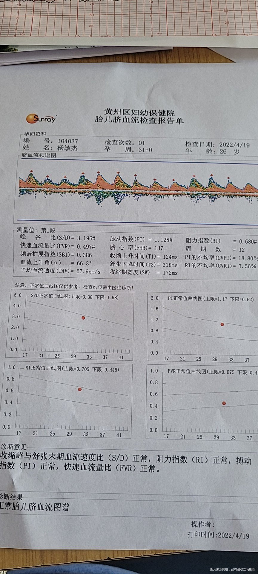 请帮我看看胎心监护正常吗和胎儿脐带流