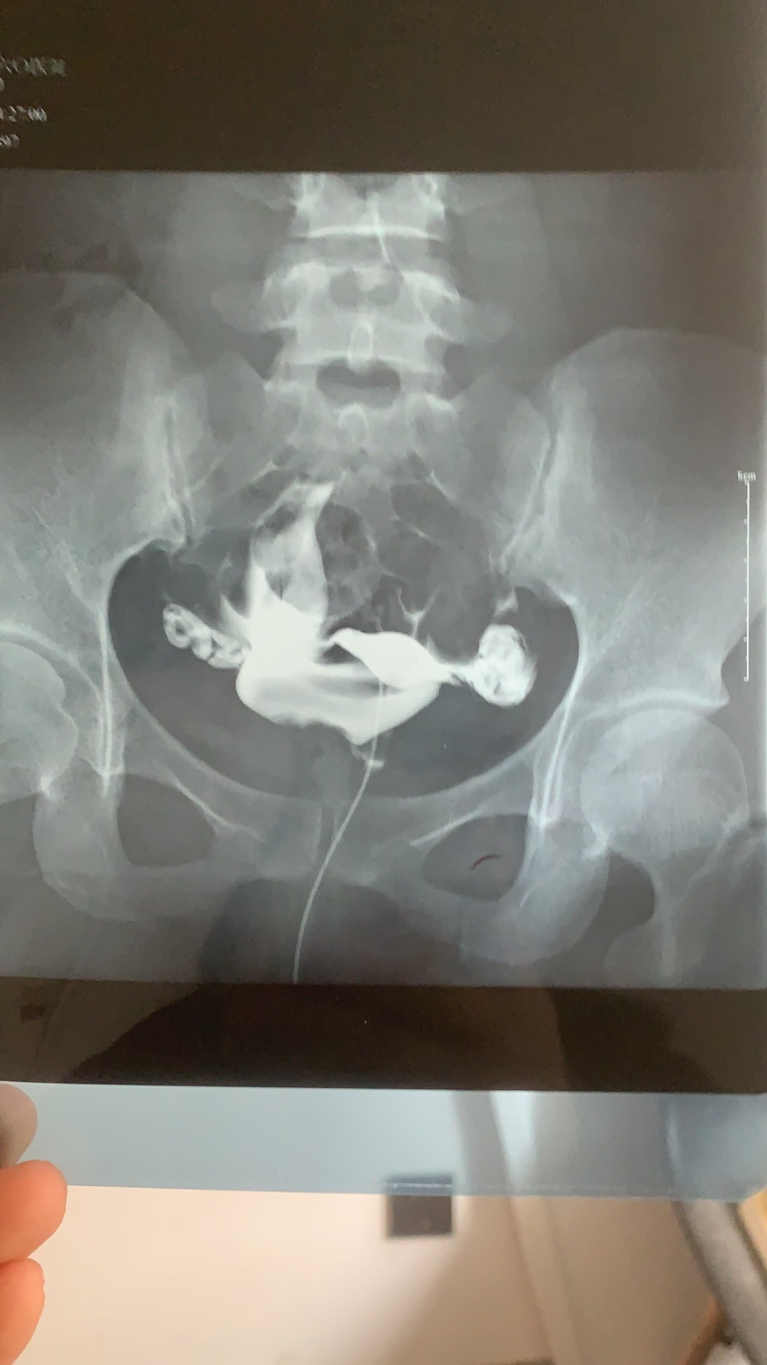 你好这种情况影响移植吗