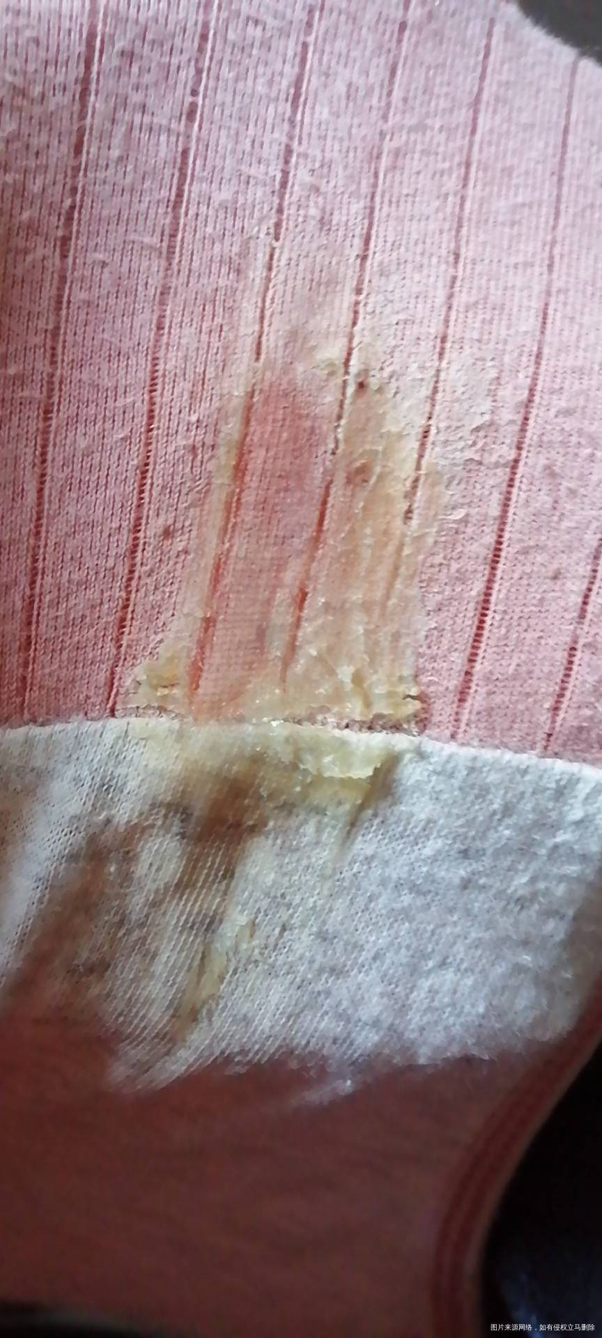 孕五个多月麻烦看一下这种白带应该怎么办