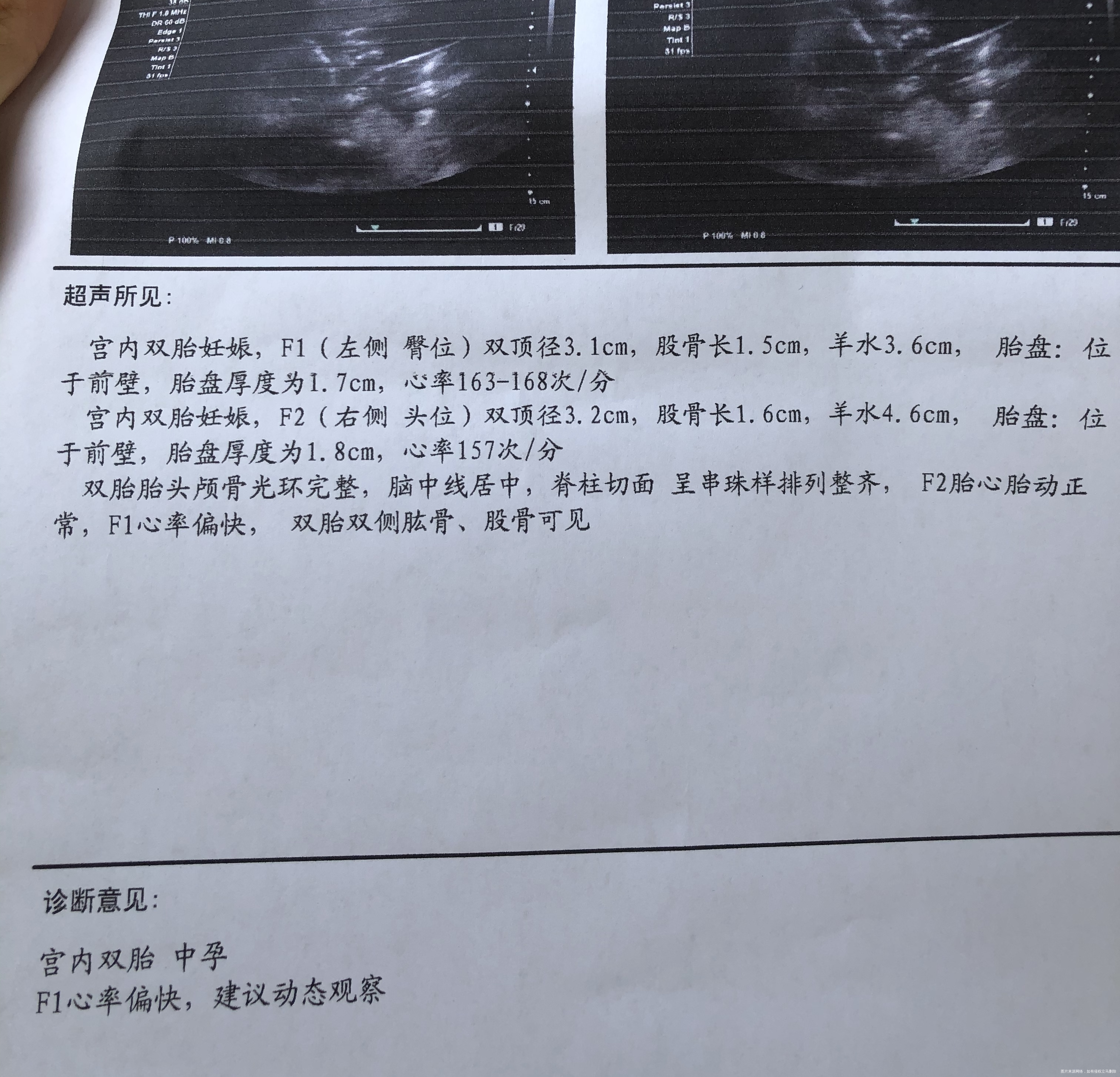 26岁双胎孕15周➕3彩超结果正常吗