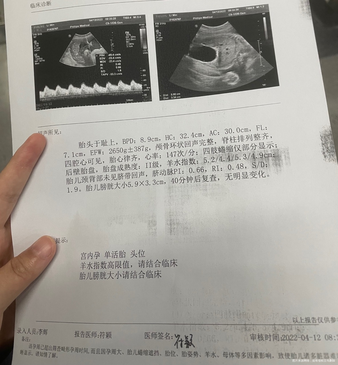 37周➕3天膀胱偏大羊水偏多胎动胎心监护都正