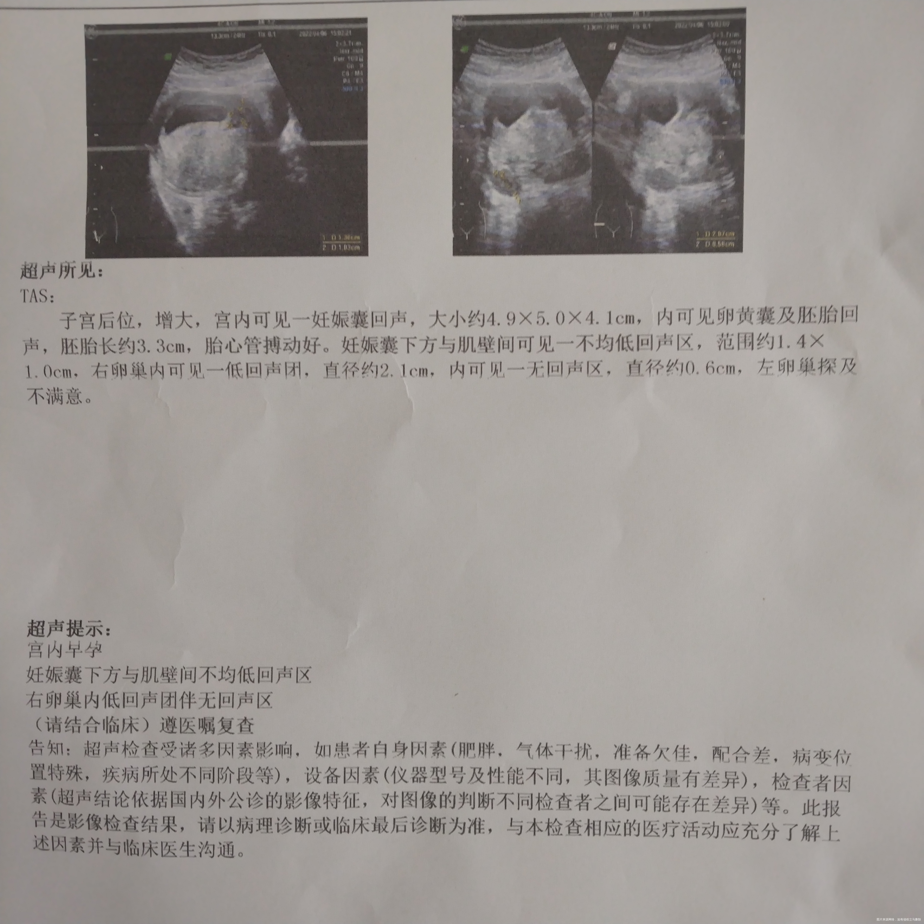 麻烦医生给我看一下b超单子正常正常吗孕10周