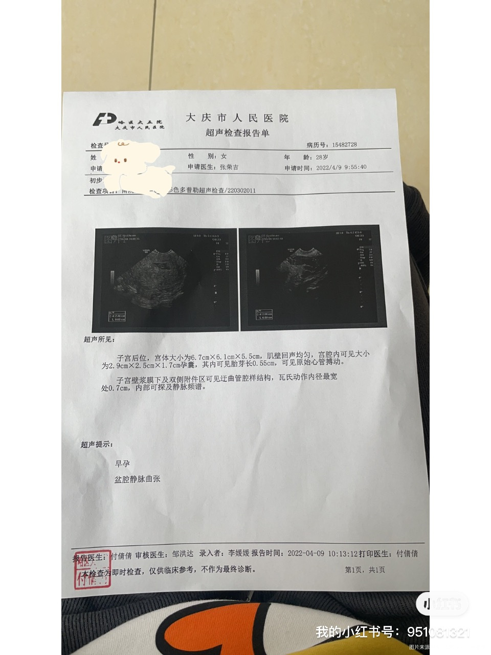 末次月经2月173月5号凌晨左右排卵4月9号