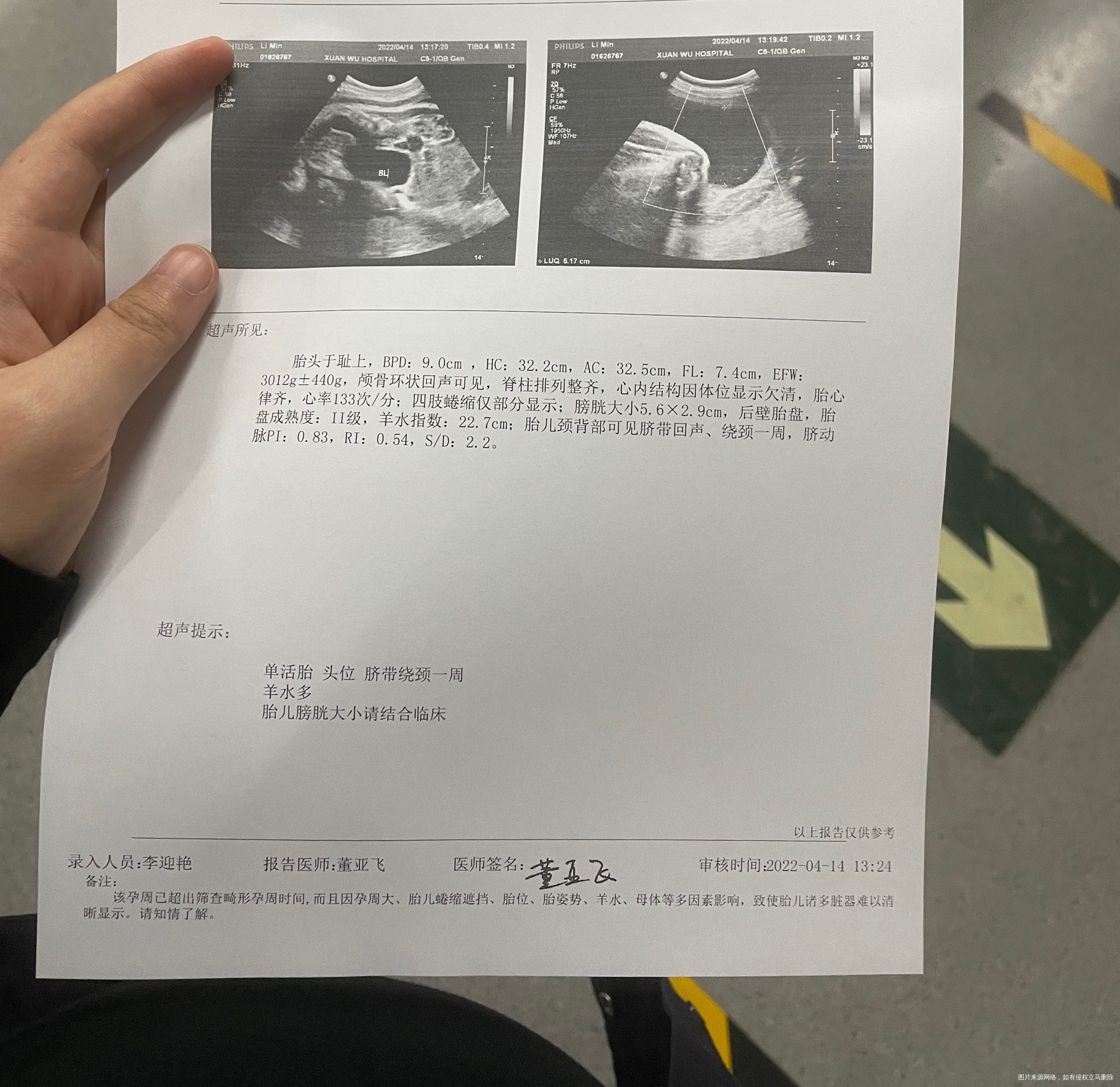 37周➕3天膀胱偏大羊水偏多胎动胎心监护都正