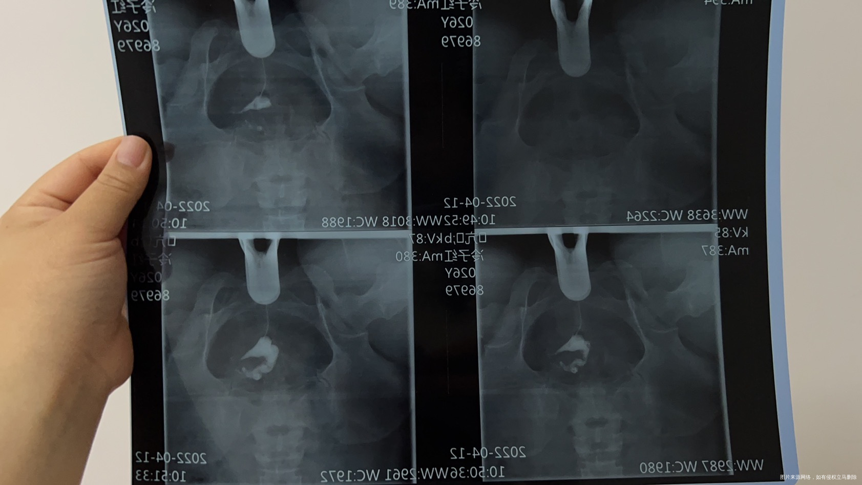 我去检查了输卵管一边积水一边堵了我想知道做试