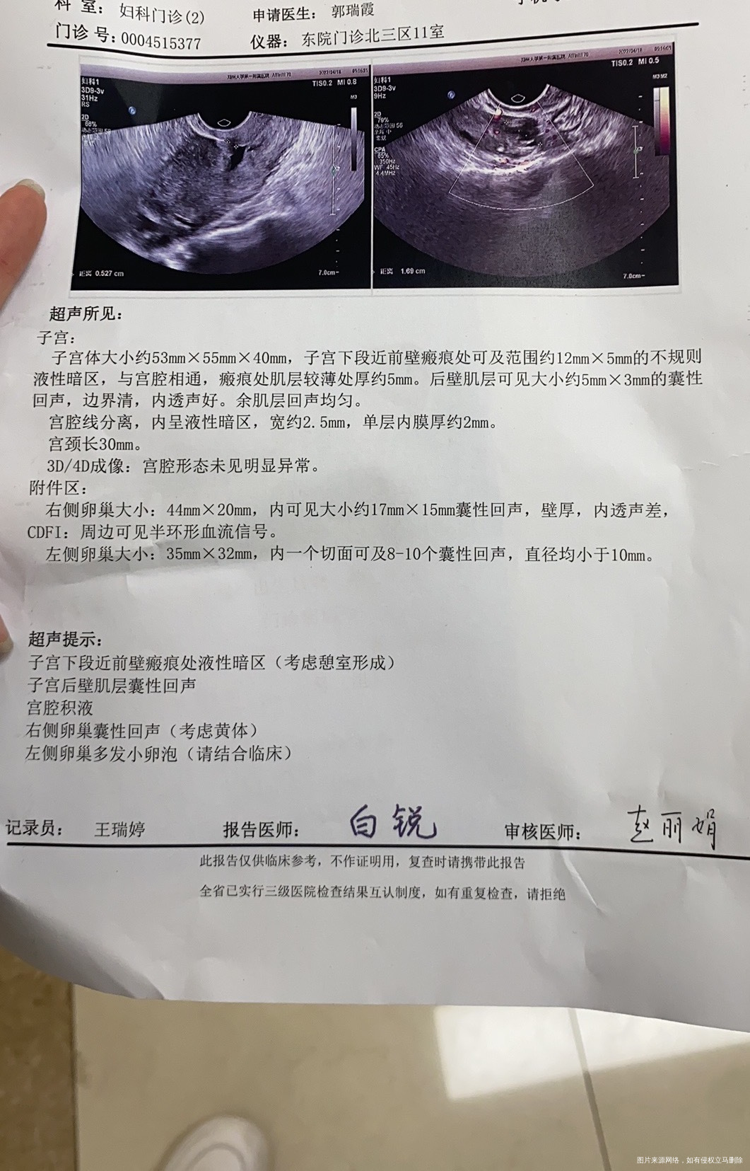 子宫憩室例假拖拉11天帮我看看要不要修复