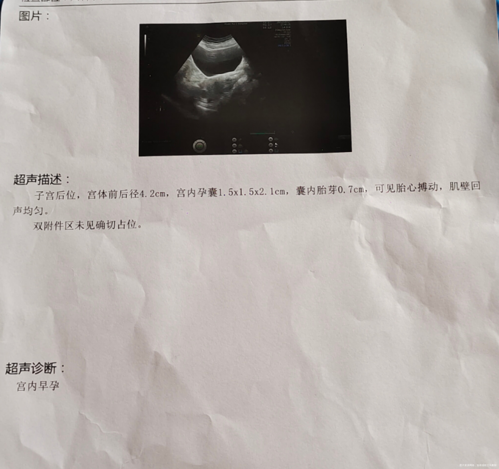 孕50天这两天只有腹胀便秘的症状胸部胀痛嗜睡