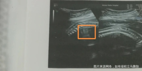 这个二维大排畸这个图是宝宝的脸吗图片是脊柱但