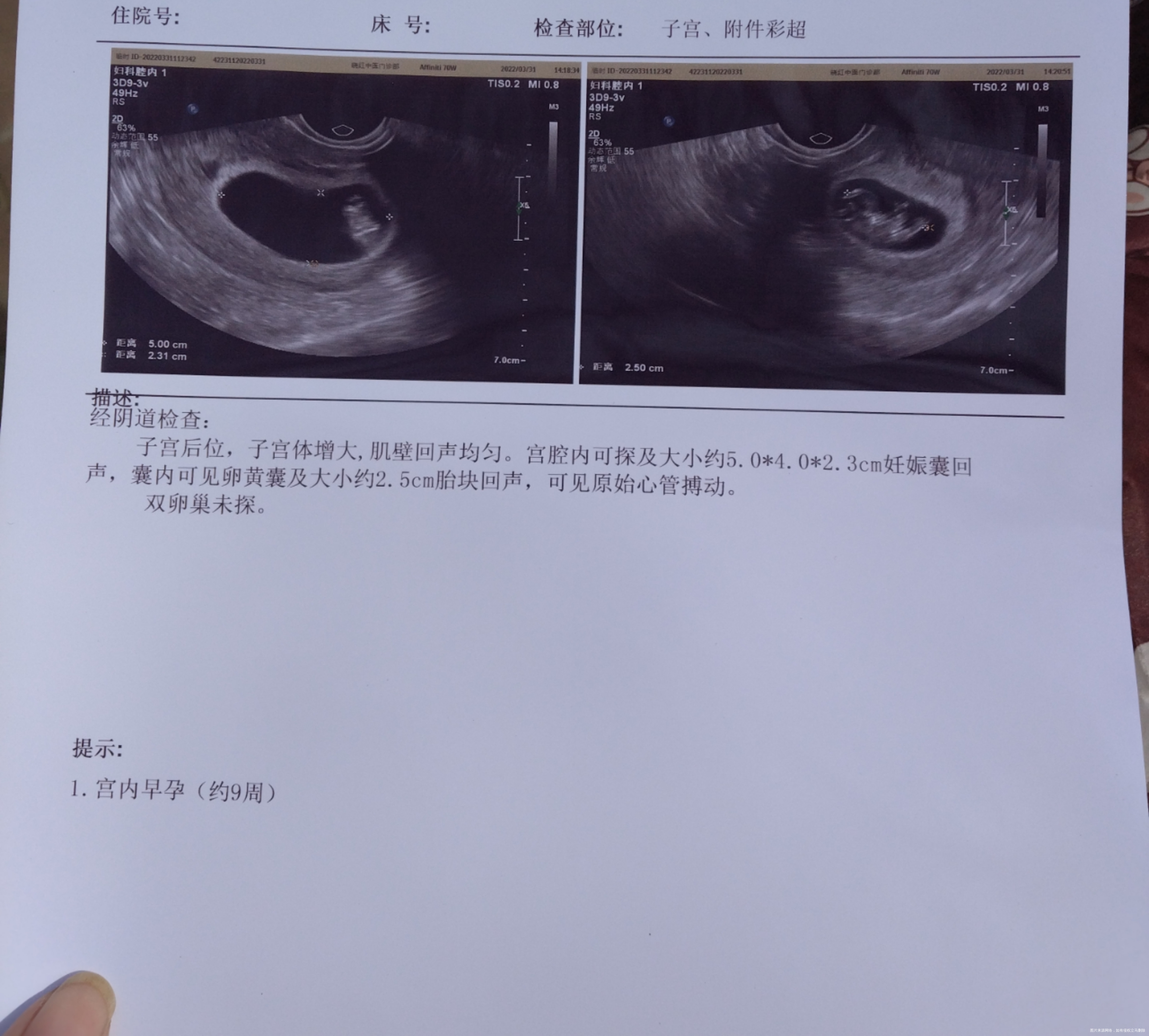 你好医生孕9周后地屈孕酮片可以减量吗目前一天