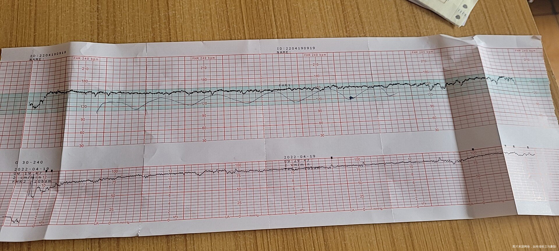 请帮我看看胎心监护正常吗和胎儿脐带流