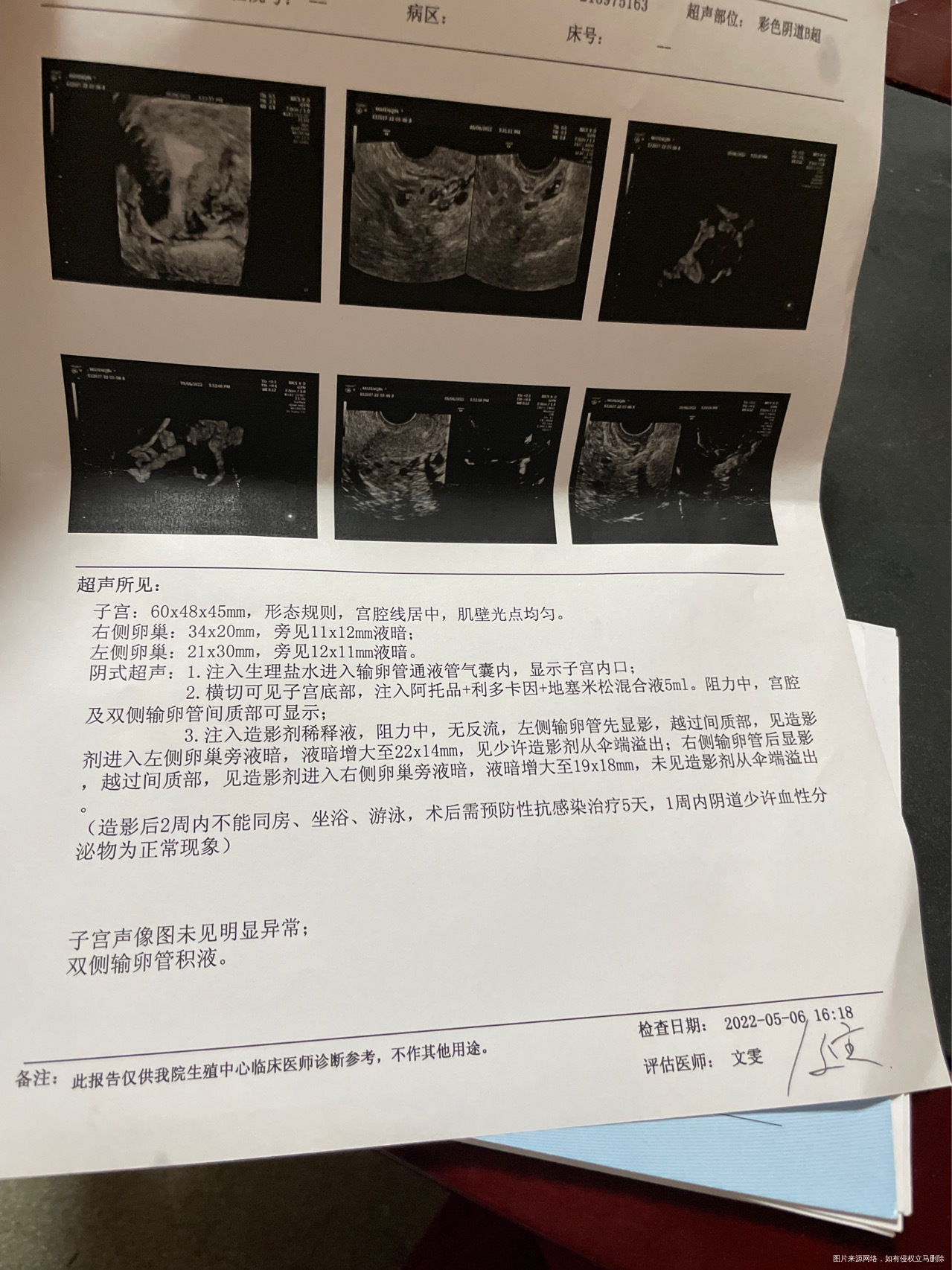 试管2次没有成功怀疑是积水今天做了造影麻烦医