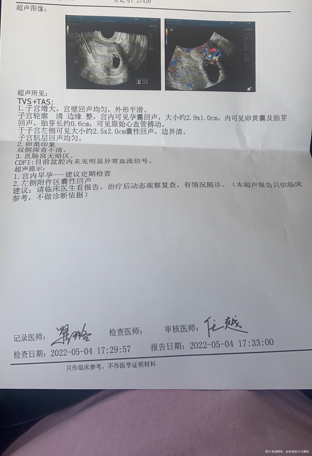 末次3月18日5月4日检查出有胎心胎芽我这孕