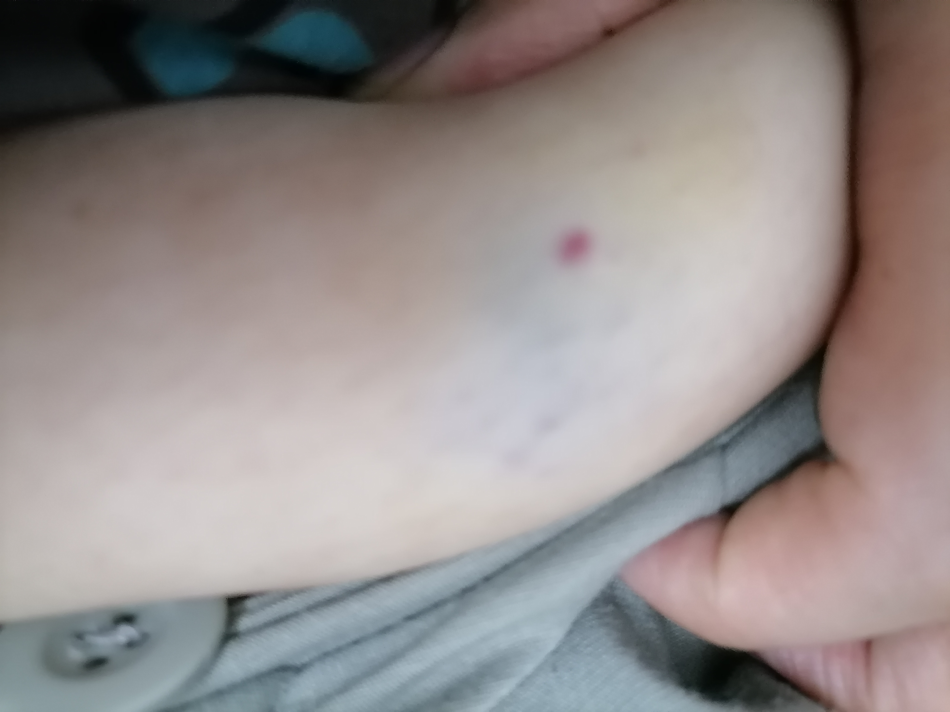 主任肝素打成这样是不是扎到血管了有点痛啊会影