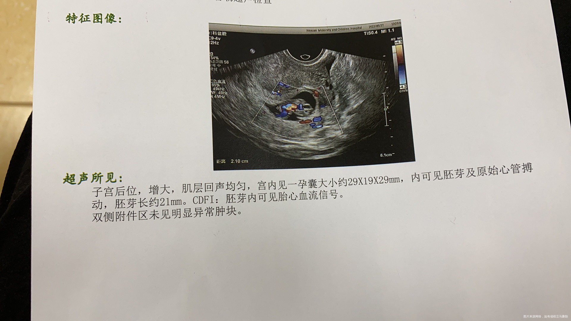 本人有多囊卵巢综合症通过四个月的优思悦调理自