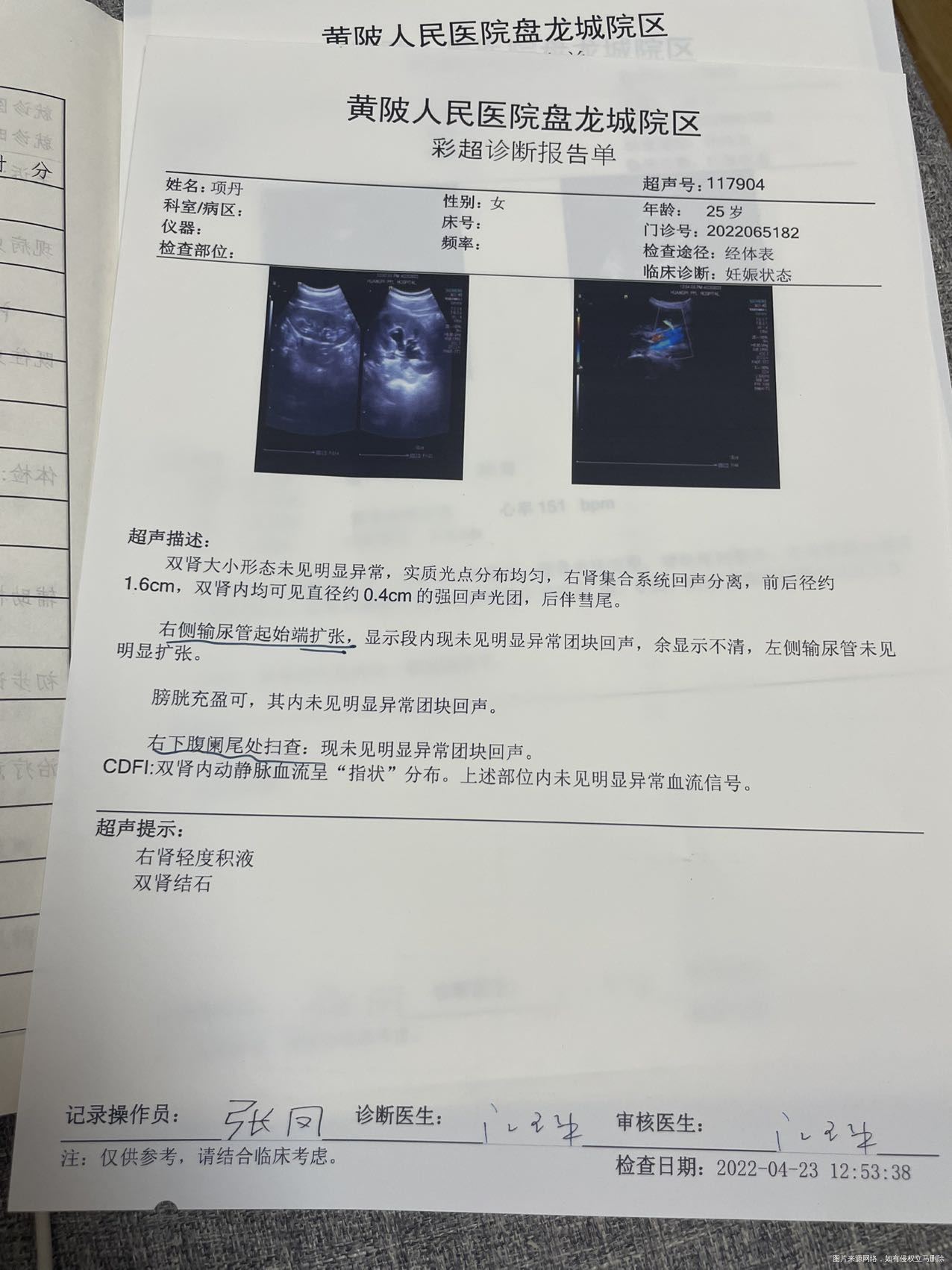 目前有小的结石怀孕中我不爱喝牛奶这些东西但是