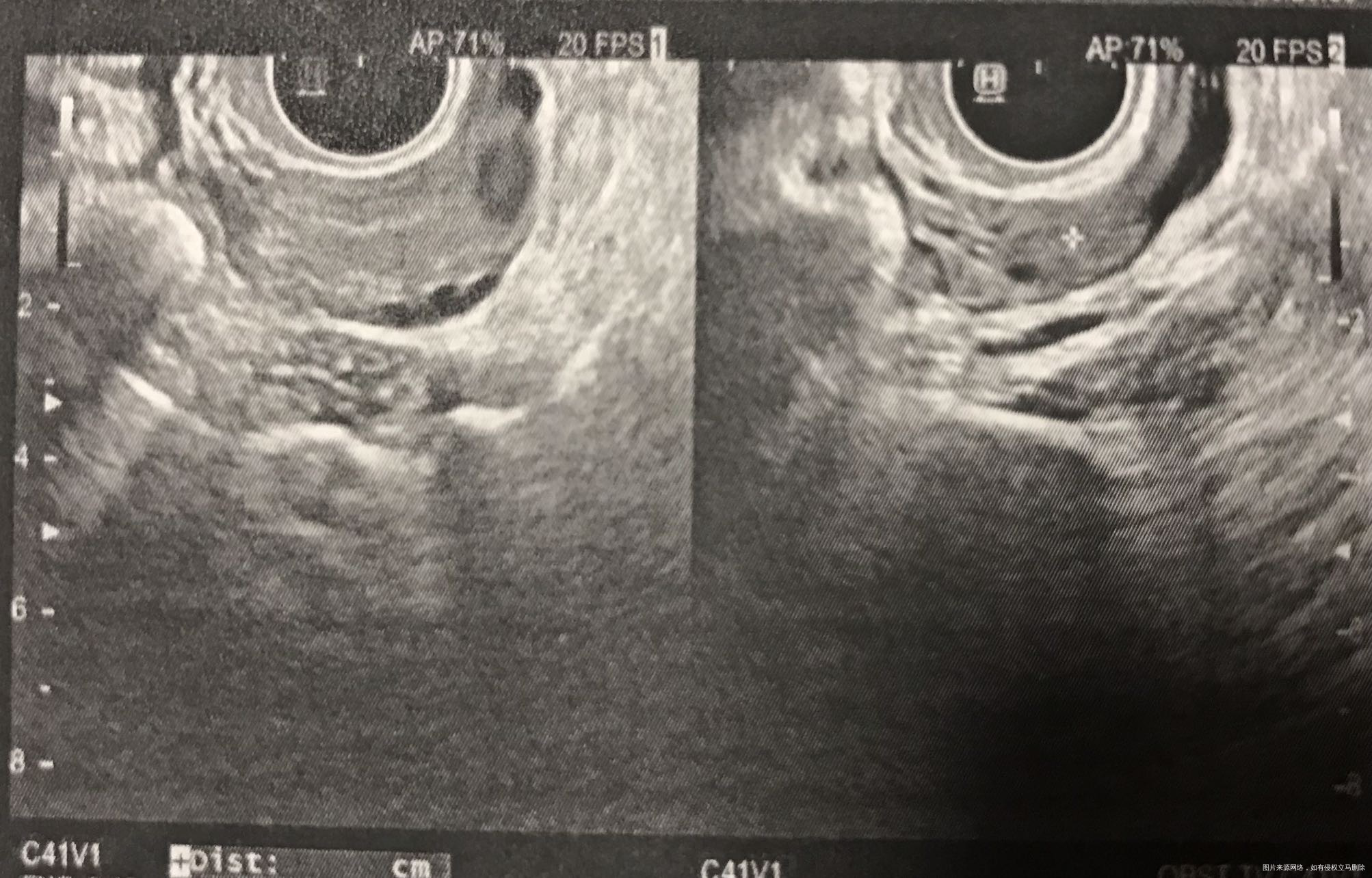 排卵后一周检查b超如图请问是不是有子宫内膜息