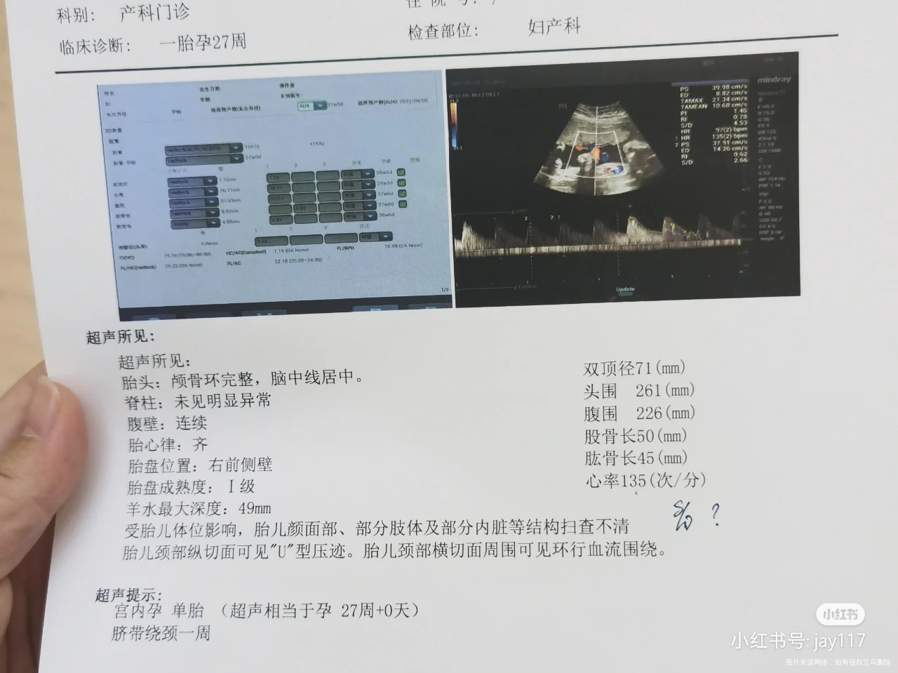 脐带绕颈一周两次B超相差十天怎么还没绕出来呢