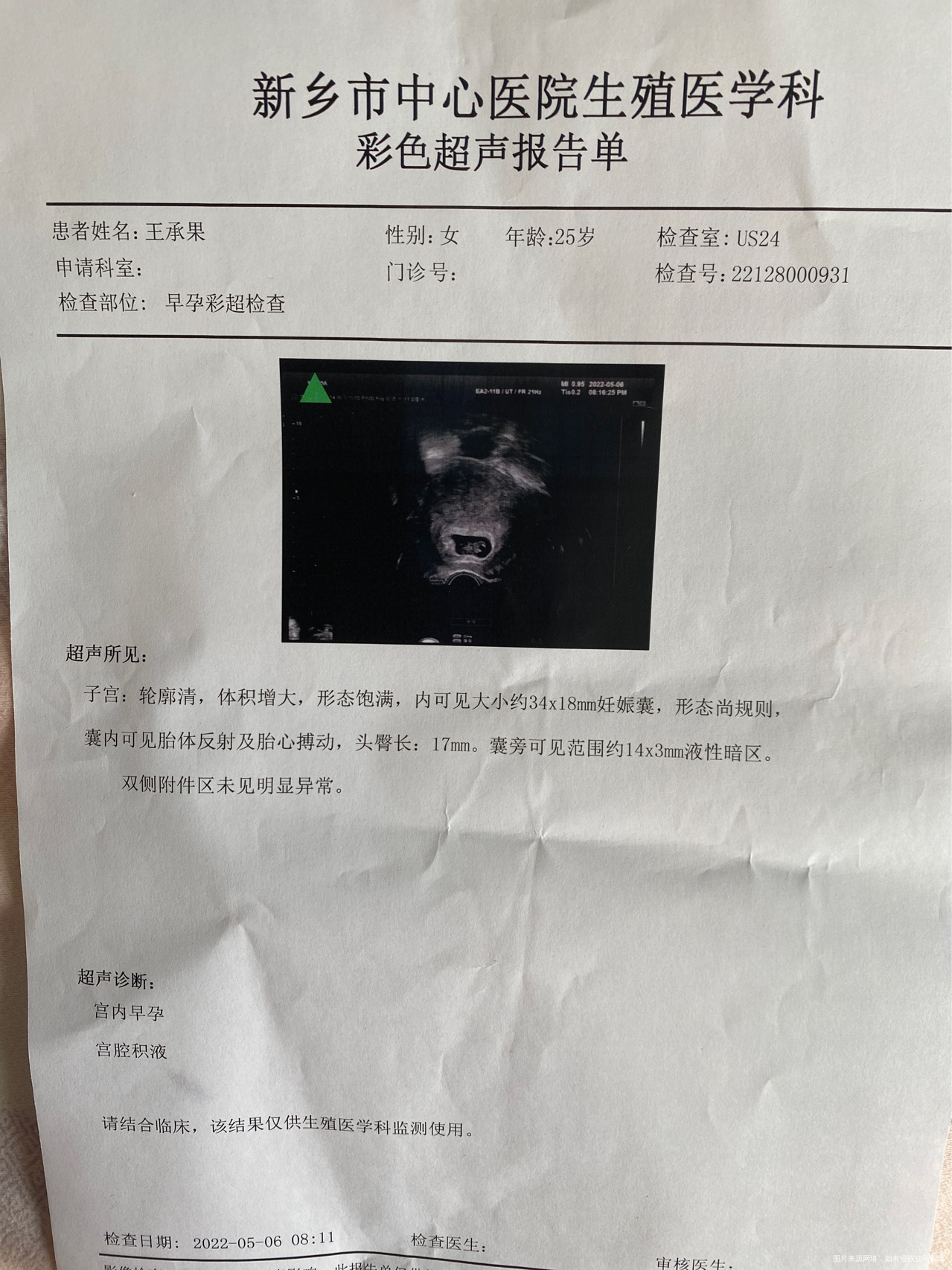 我是促排卵怀孕的末次月经218318号打的破