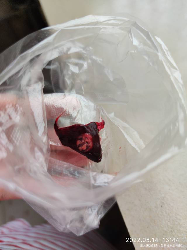 这是孕6周胎停排出来的胚胎吗要拿去化验不认识