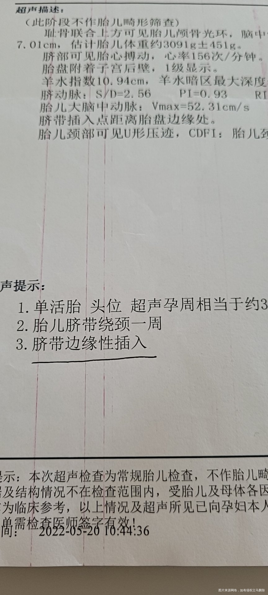 脐带边缘性插入生产有影响吗