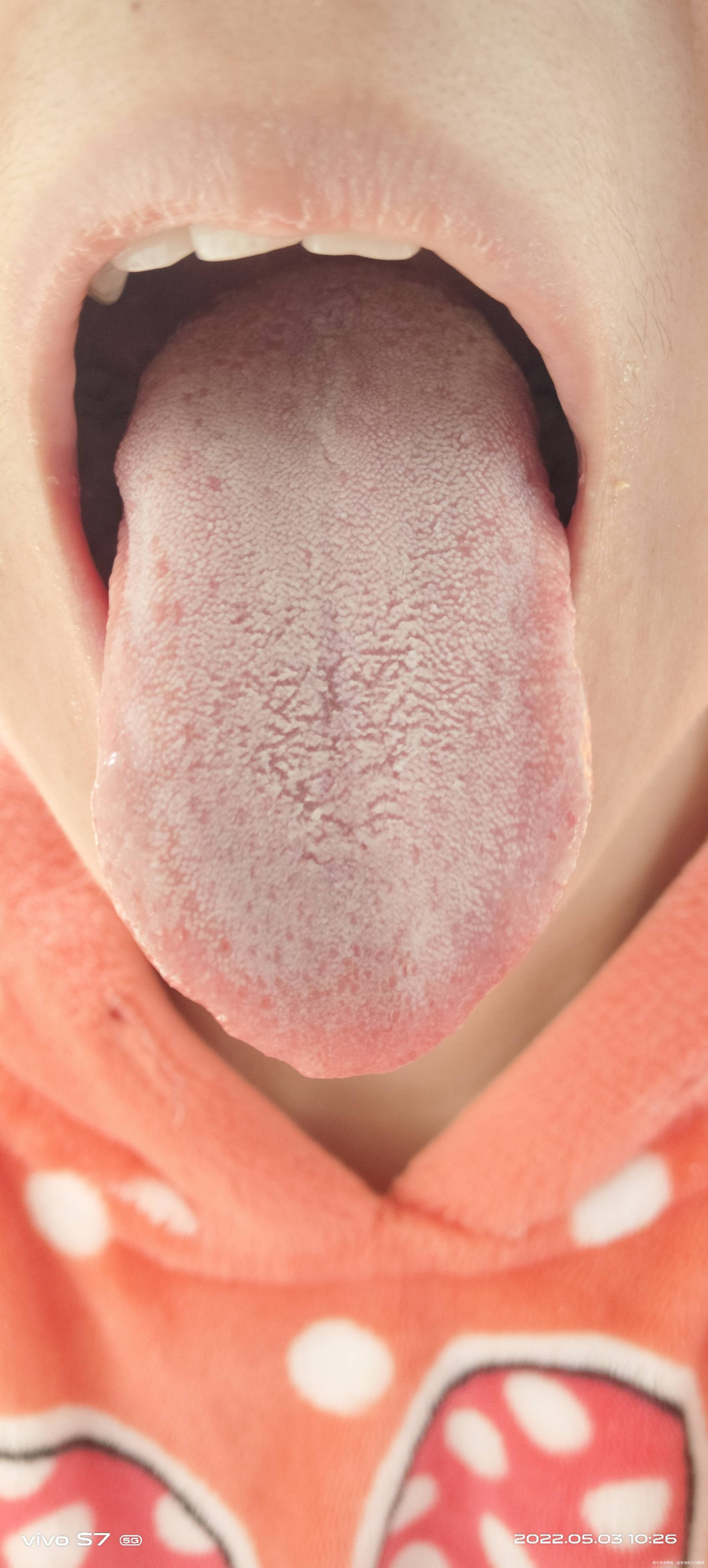 孕早期舌苔发白怎么回事呢吃啥都没胃口又胀气又