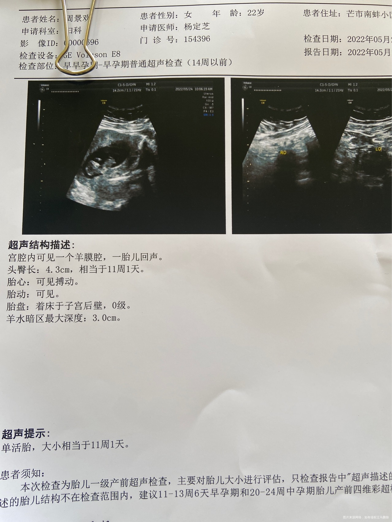 孕11周多囊有胎停史最近吃地屈孕酮片早一颗晚