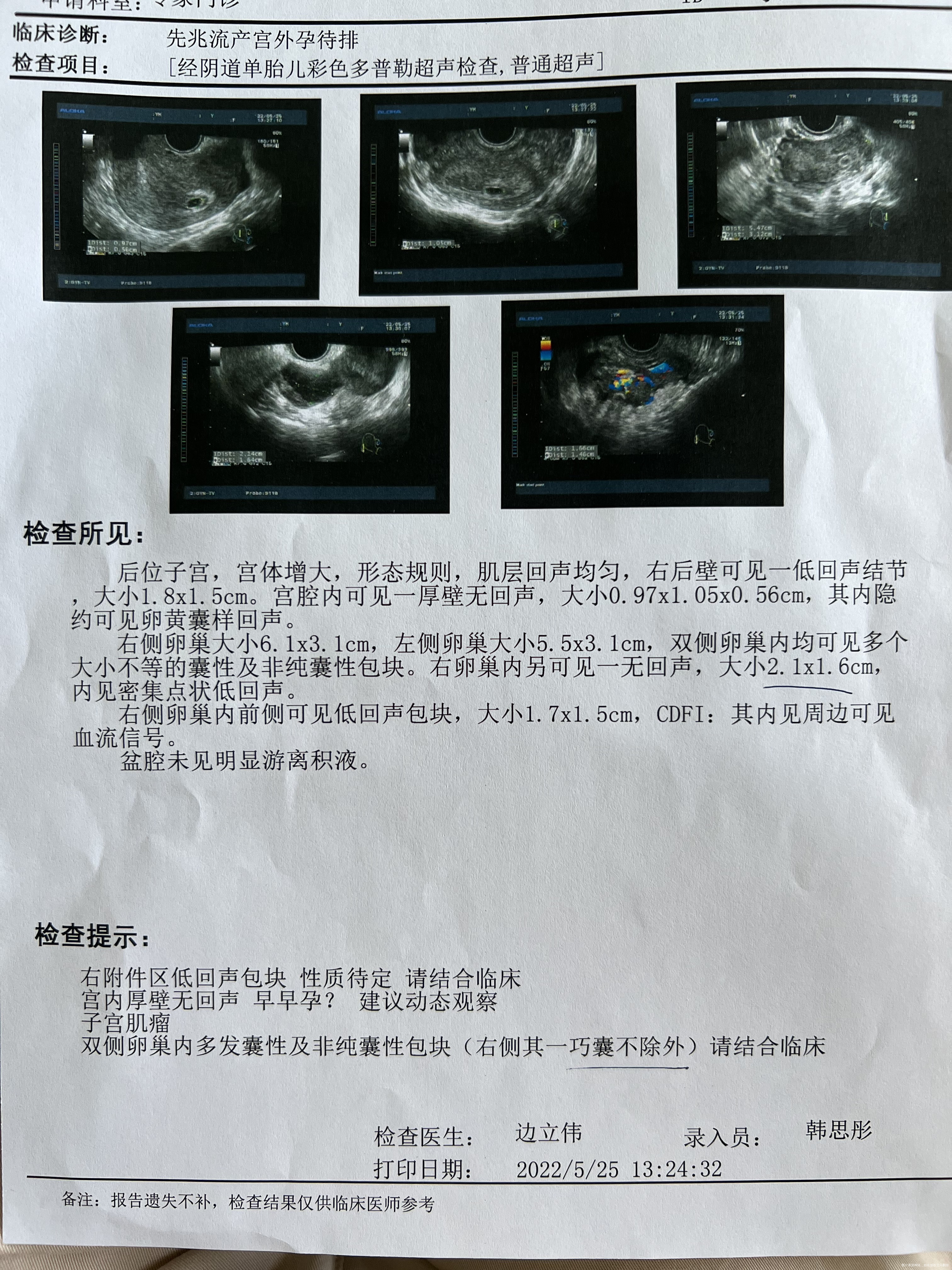 我5月3日移植的两枚鲜胚18天的时候出褐色的