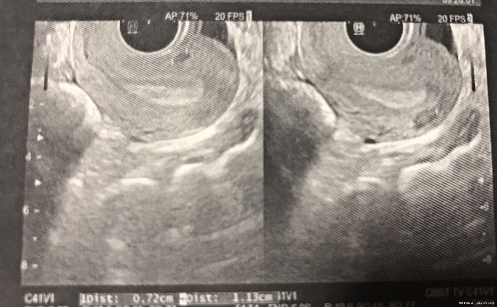 排卵后一周检查b超如图请问是不是有子宫内膜息