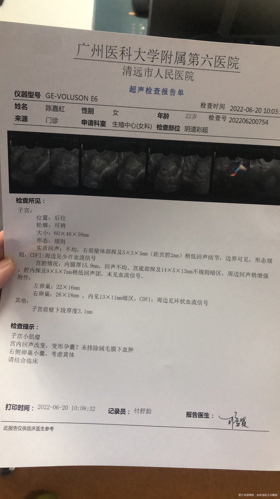 15年试过侵蚀性葡萄胎化疗4次18年之前试过