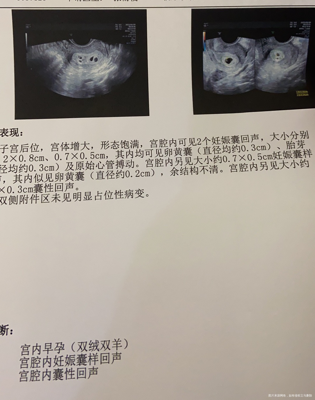 孕6周我的hcg不高但是b超显示如图说明什么