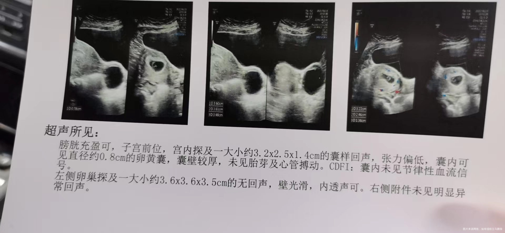 怀孕8周之前生过2个都是剖的这回说孩子长在胎