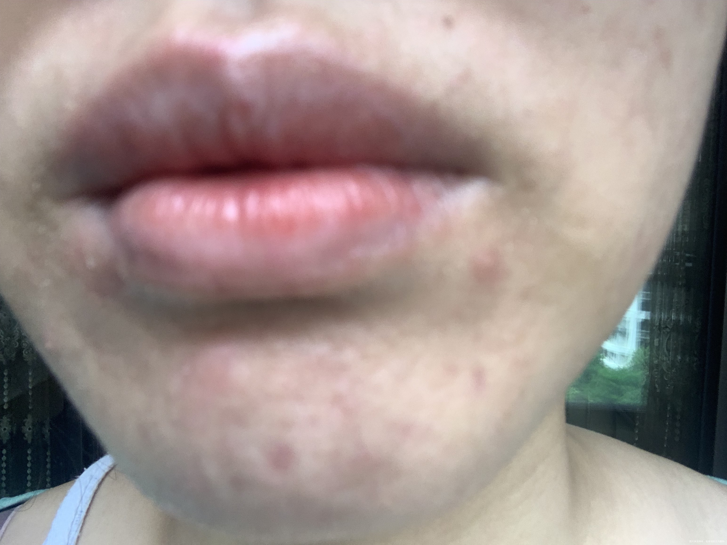 上下嘴唇内侧红肿刺痛涂抹茶油则一直脱皮该如何