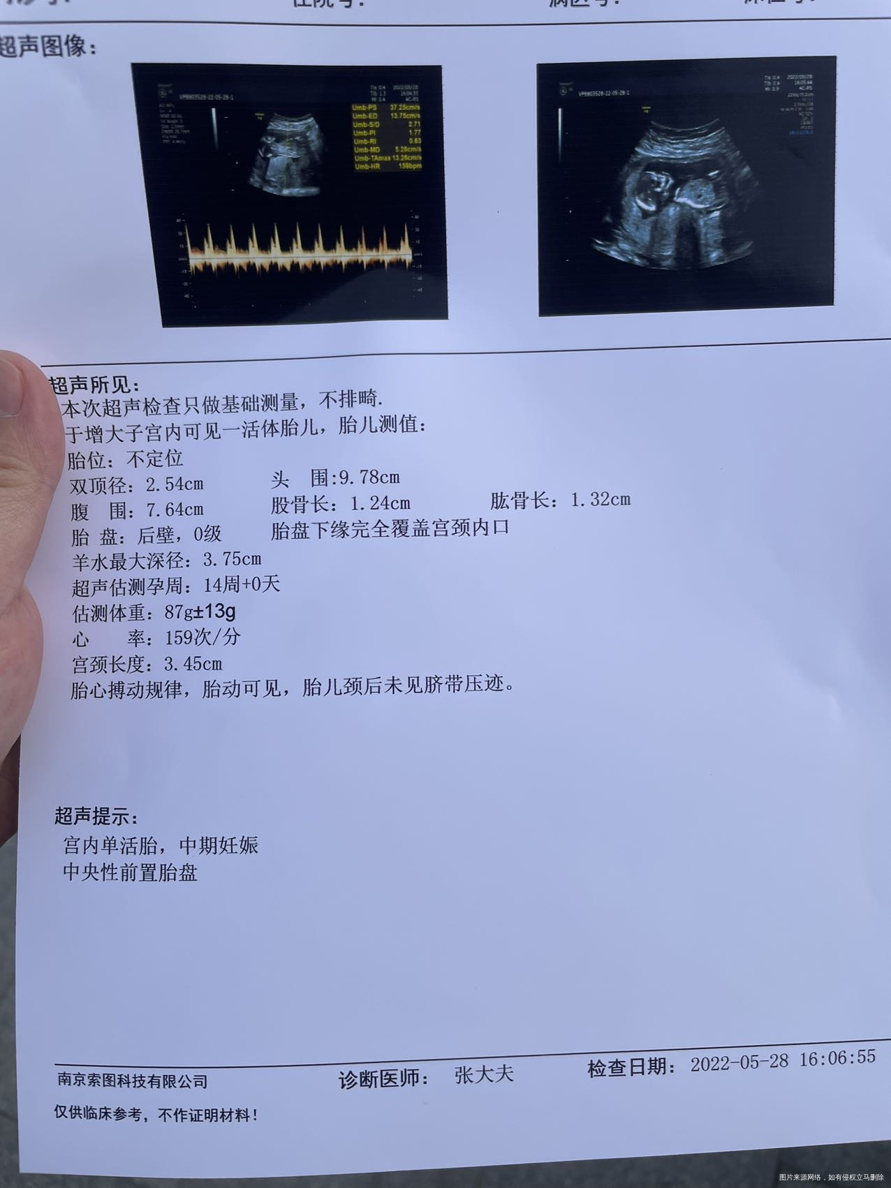 医生您好我14周的时候去检查医生说我胎盘安全