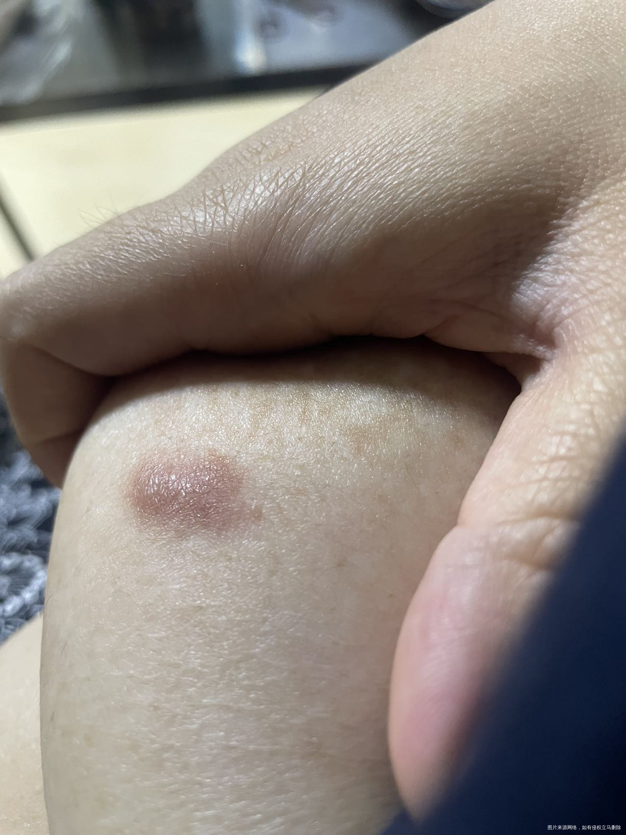 医生您好我胸上现在长了一个疙瘩有时候会有一点