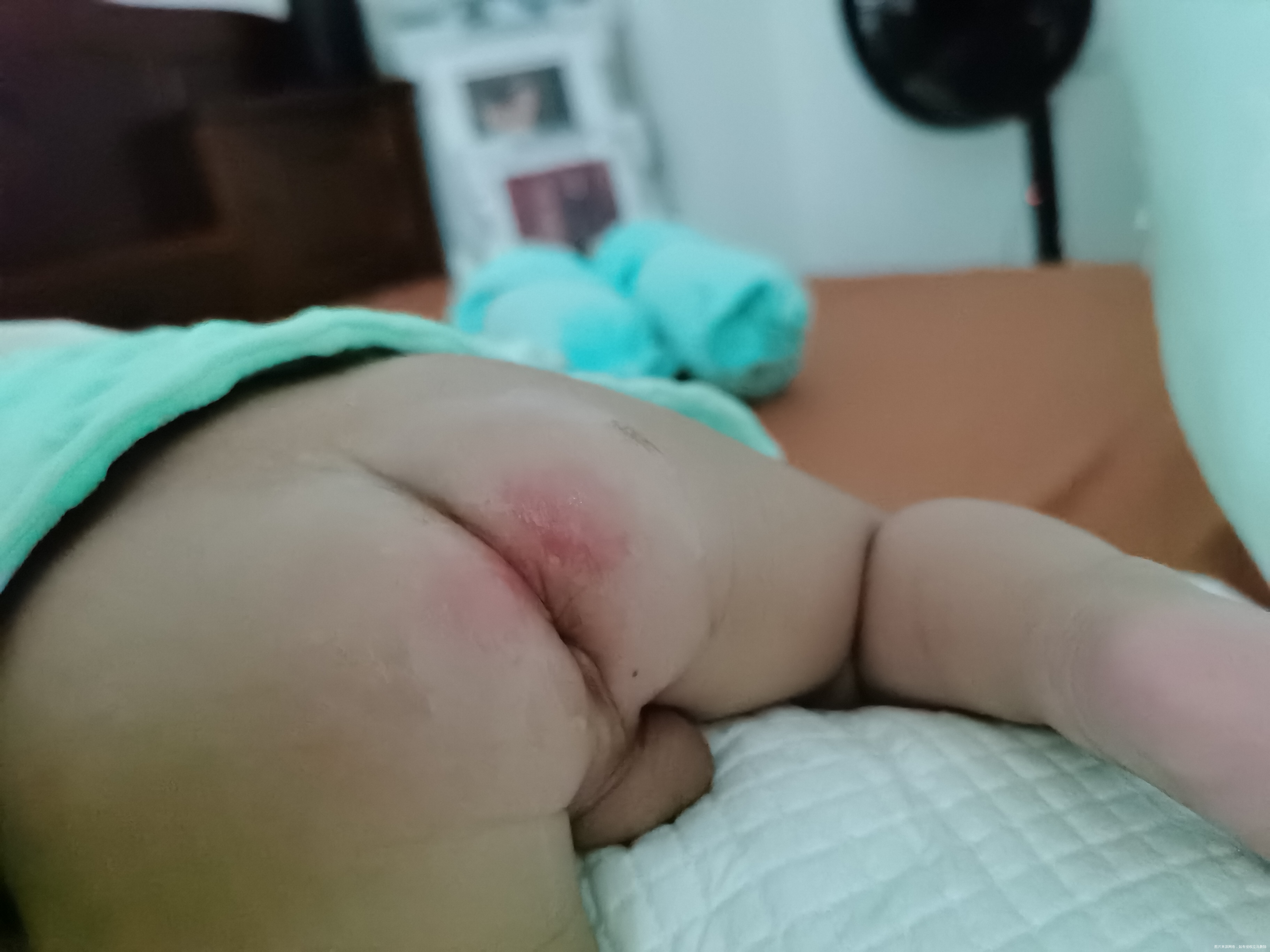 宝宝红屁屁怎么办需要擦药膏吗