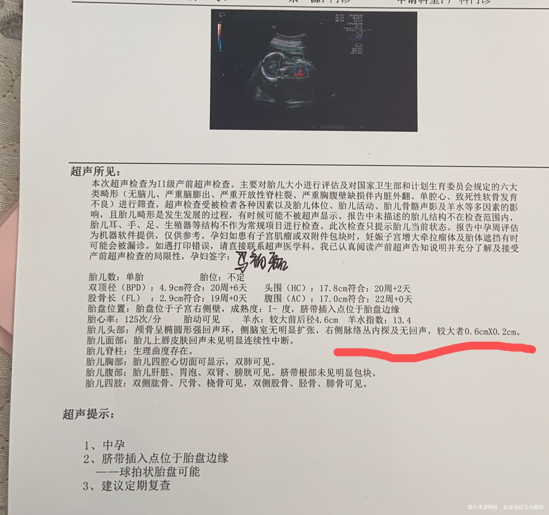 孕20周去检查B超显示右侧脉络层内无回声是囊