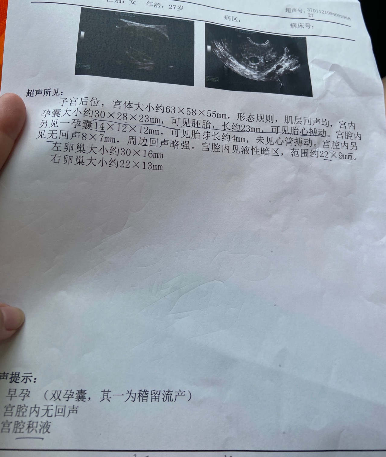 孕十周双孕囊一个发育不行了另外一个最大的胎儿
