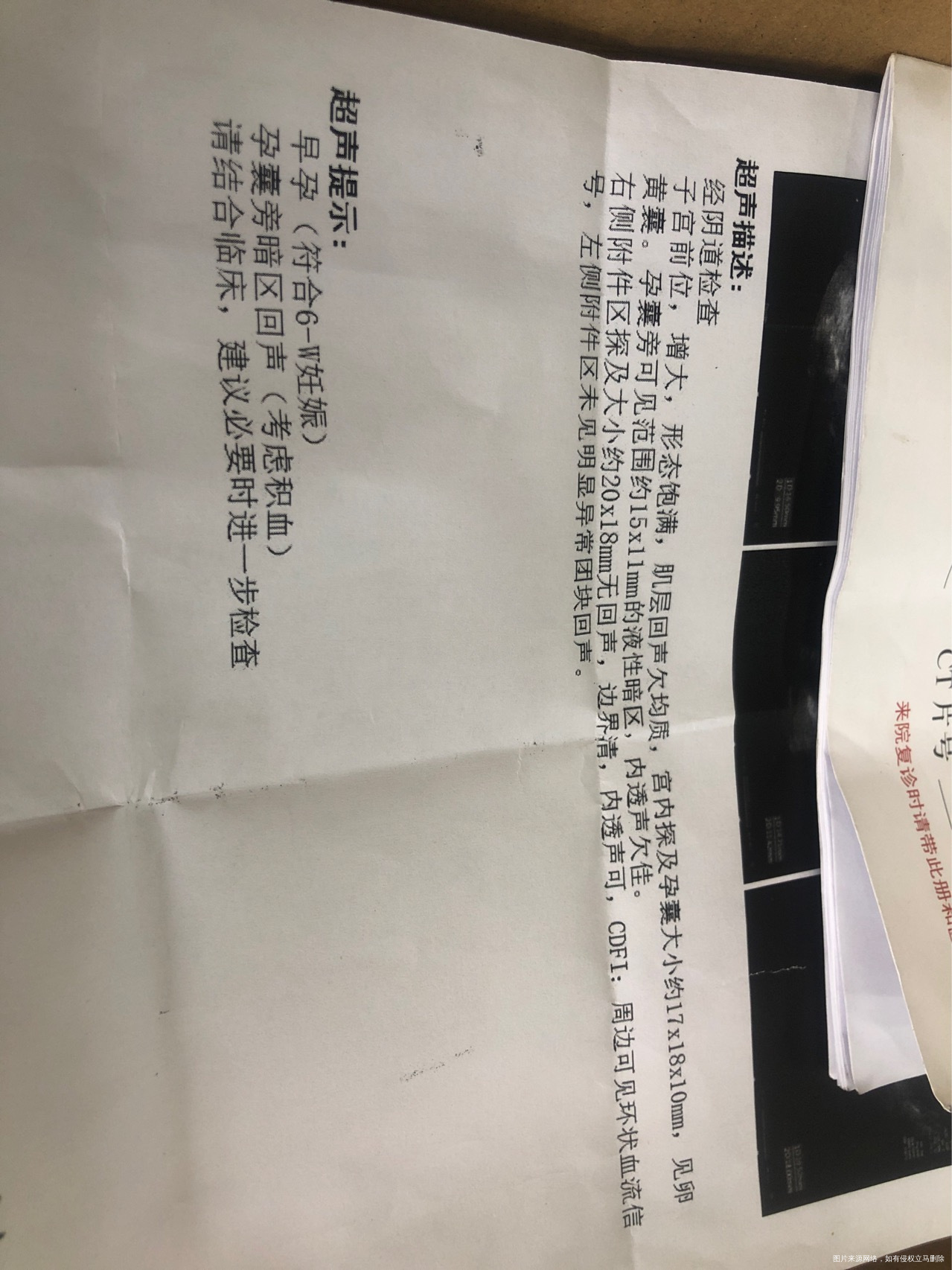 说怀疑宫腔积血这个严重吗