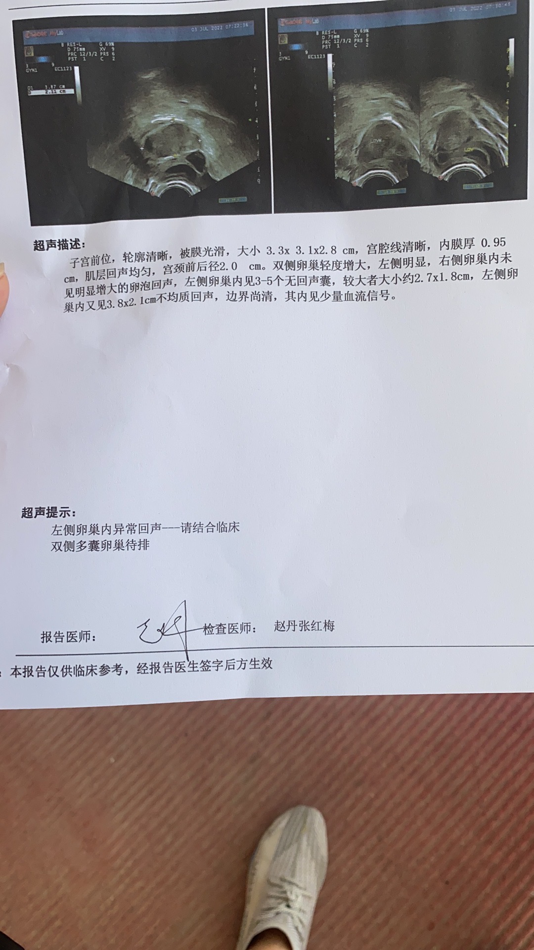 试管取卵34个第11天在普通医院做了个b超想