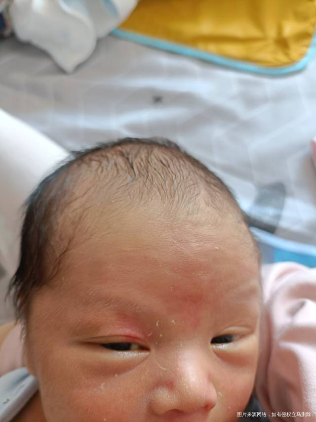 各位大夫我想问问宝宝出生右眼皮那里和两眉毛中