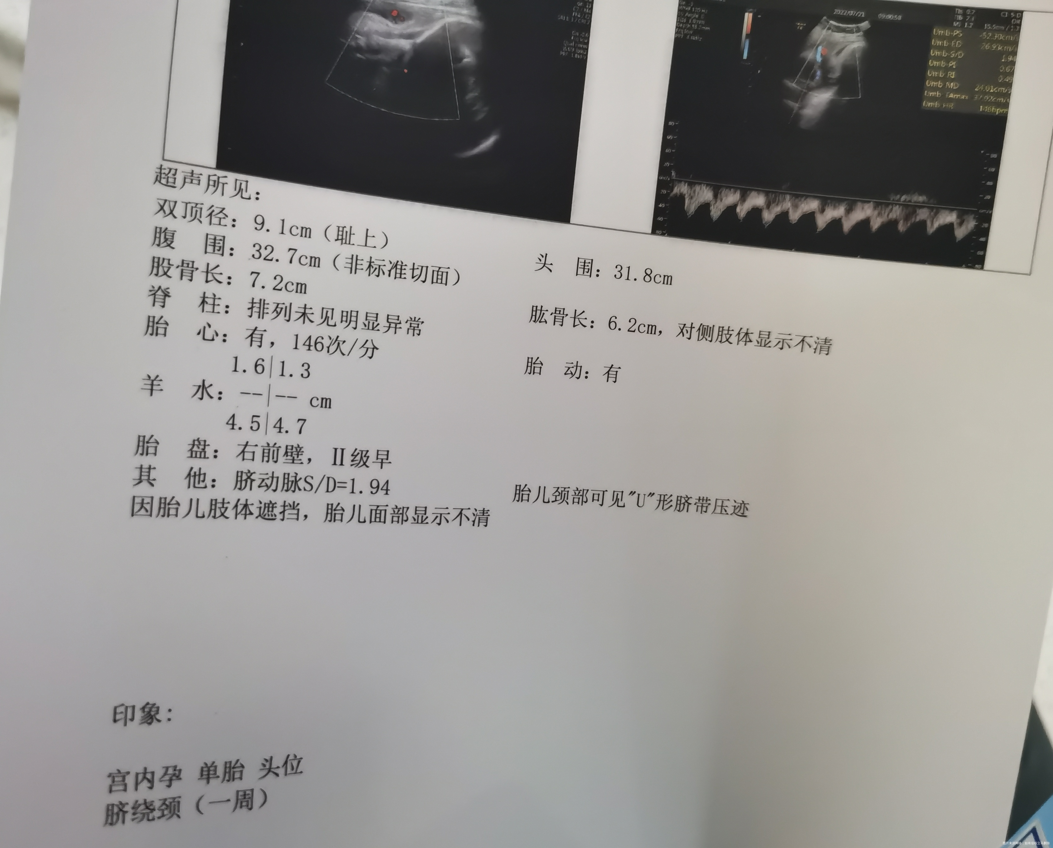 36+6这个脐动脉S/D值正常吗