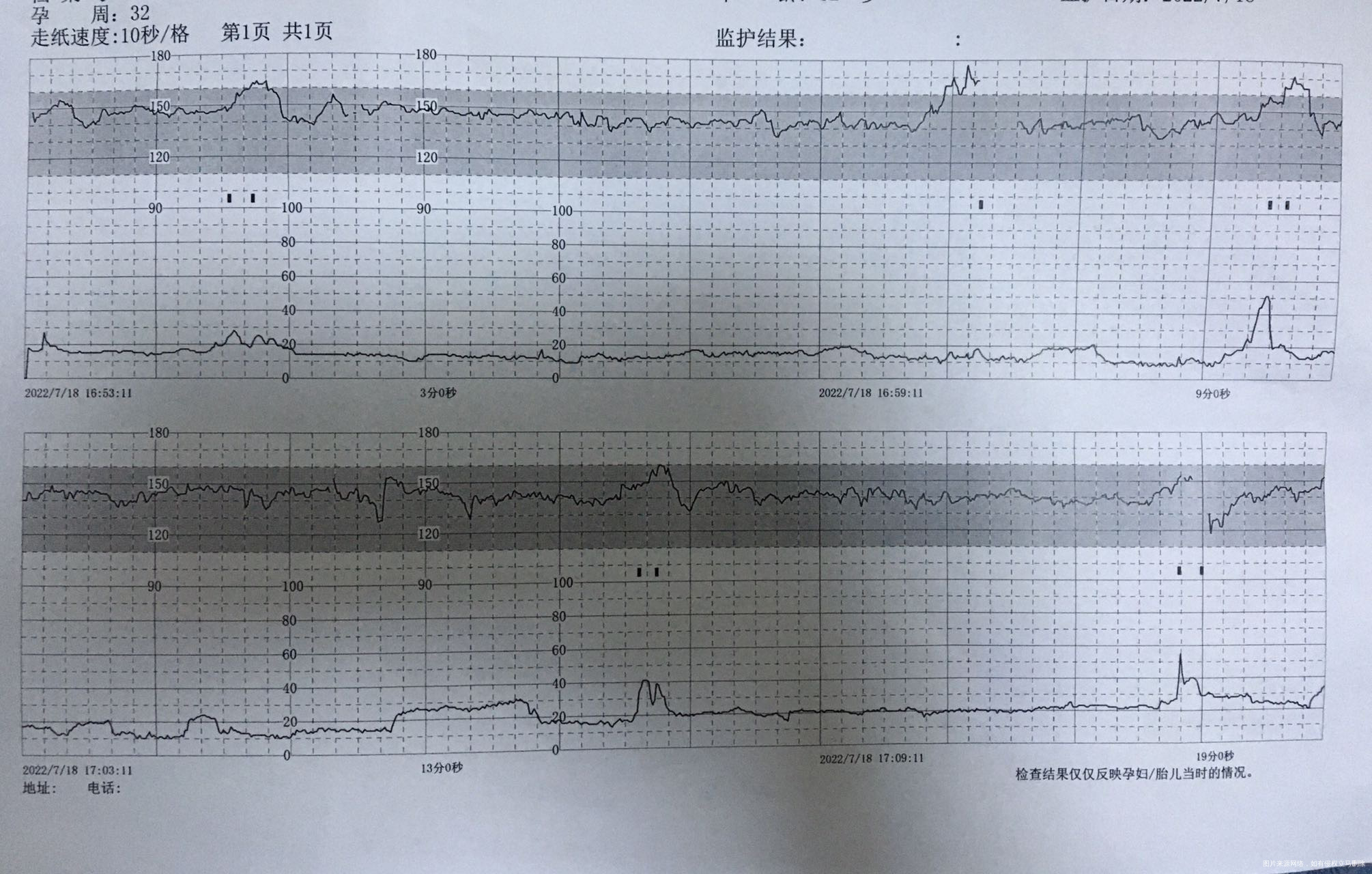 胎心监护怎么看结果正常吗
