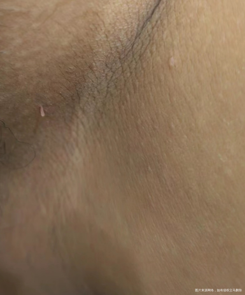 大腿根涨了这个肉锥这是咋回事是hpv吗孕晚期
