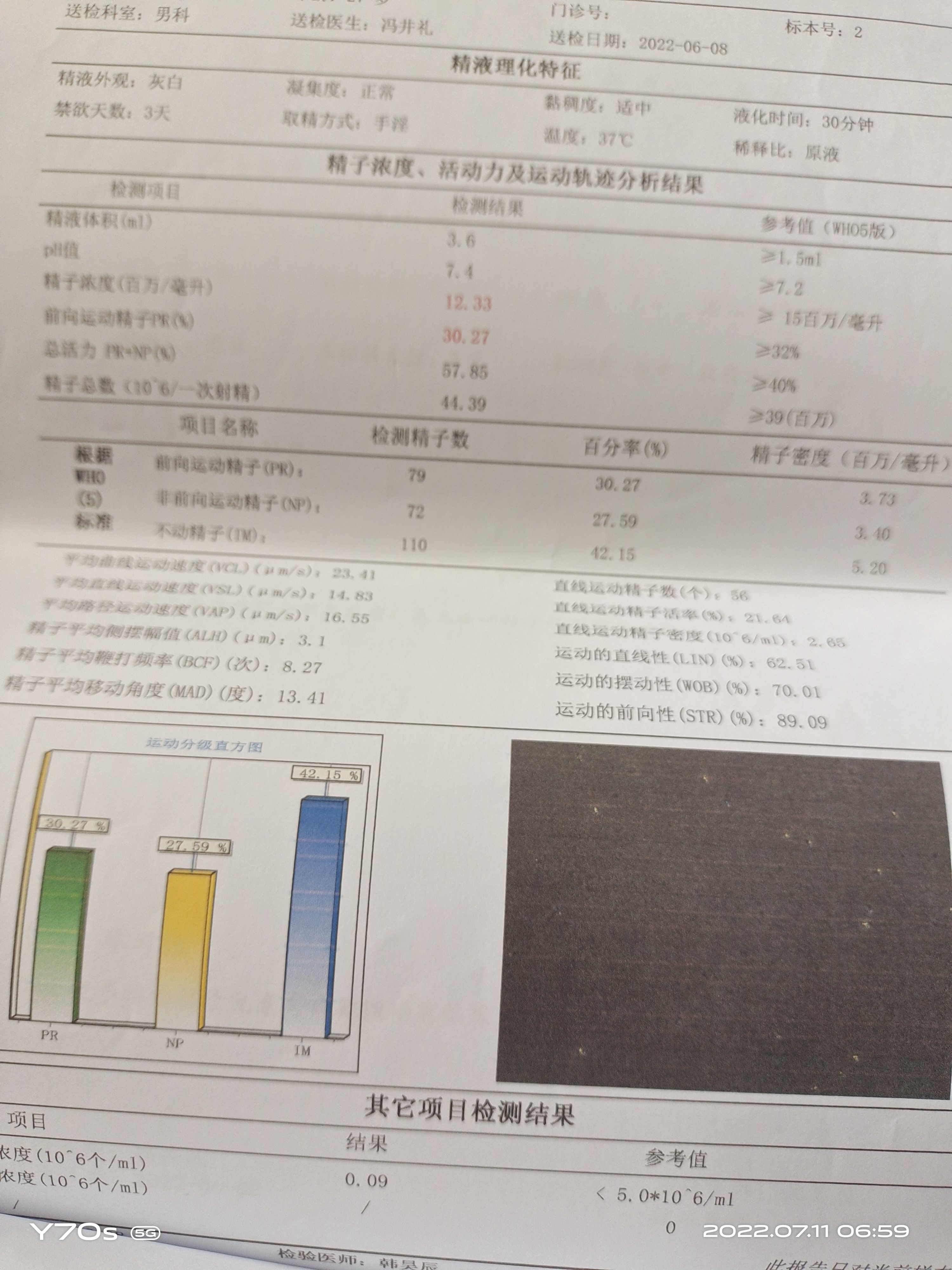 医生你好麻烦帮忙看看这个精索静脉曲张需要手术