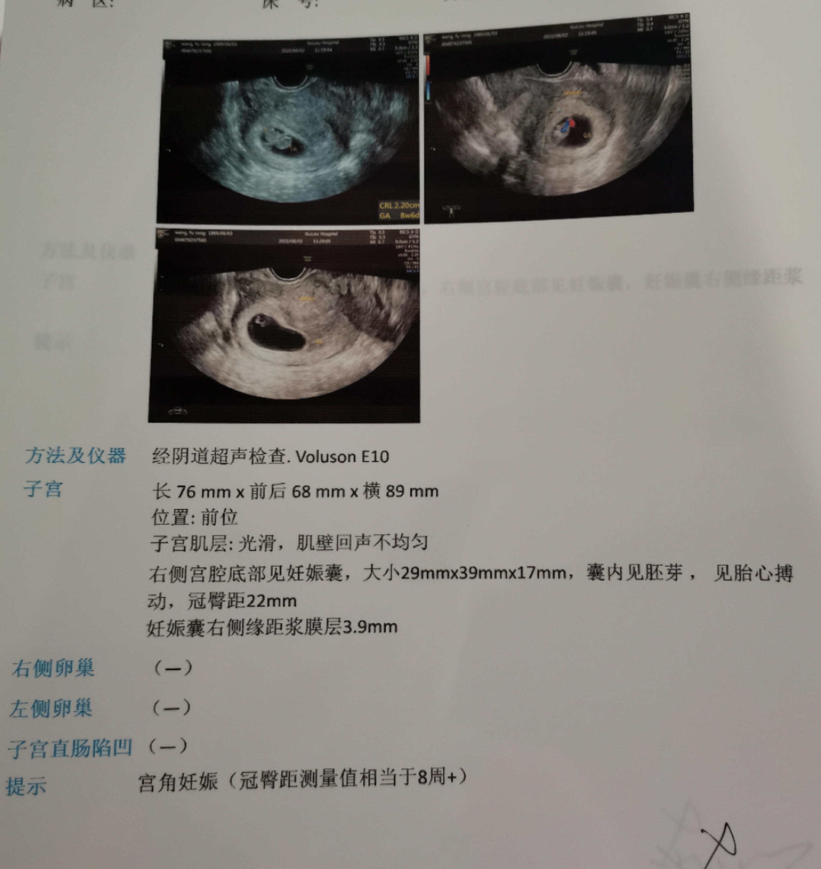 孕九周孕囊偏右侧近宫角最薄处39mm这种情况