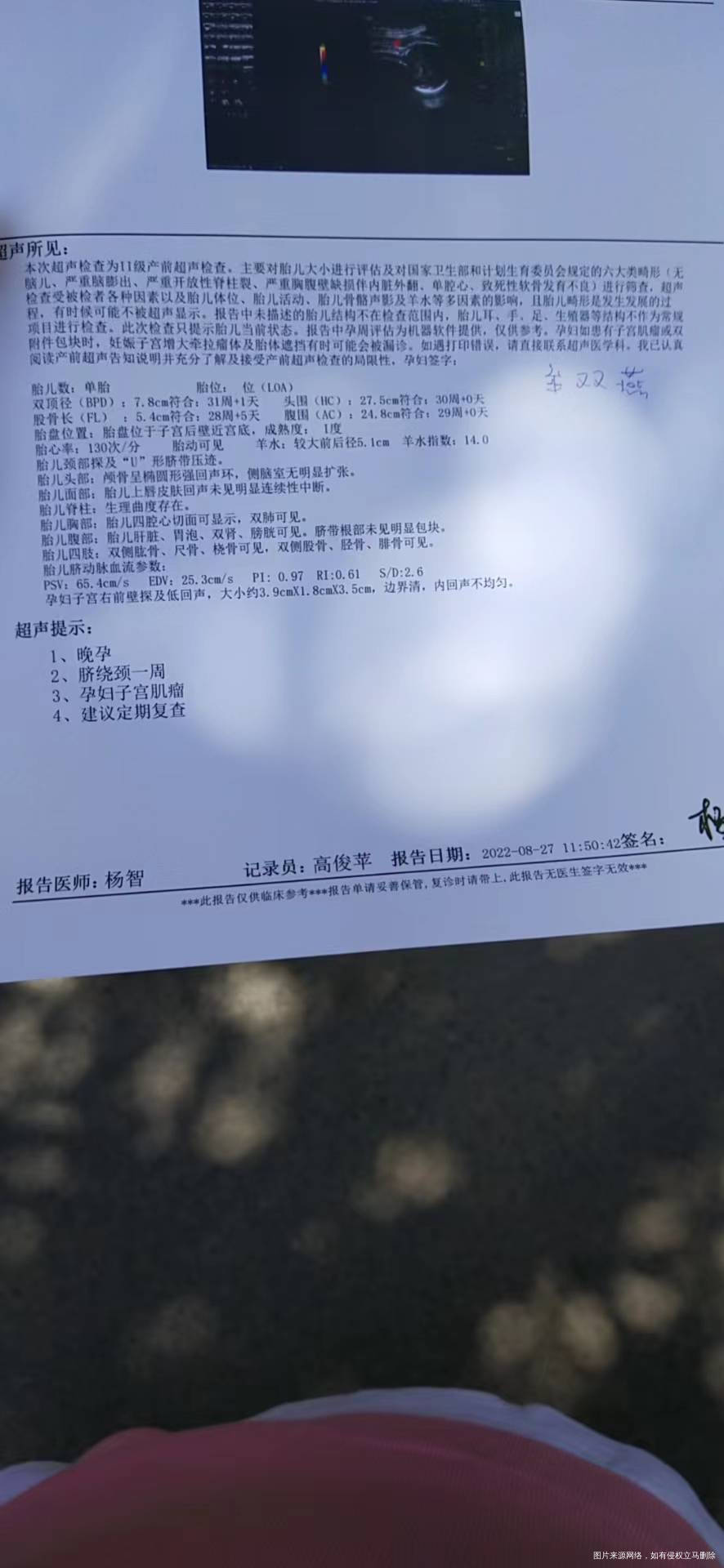 大夫这个肌瘤怎么办有影响吗以前没看到啊