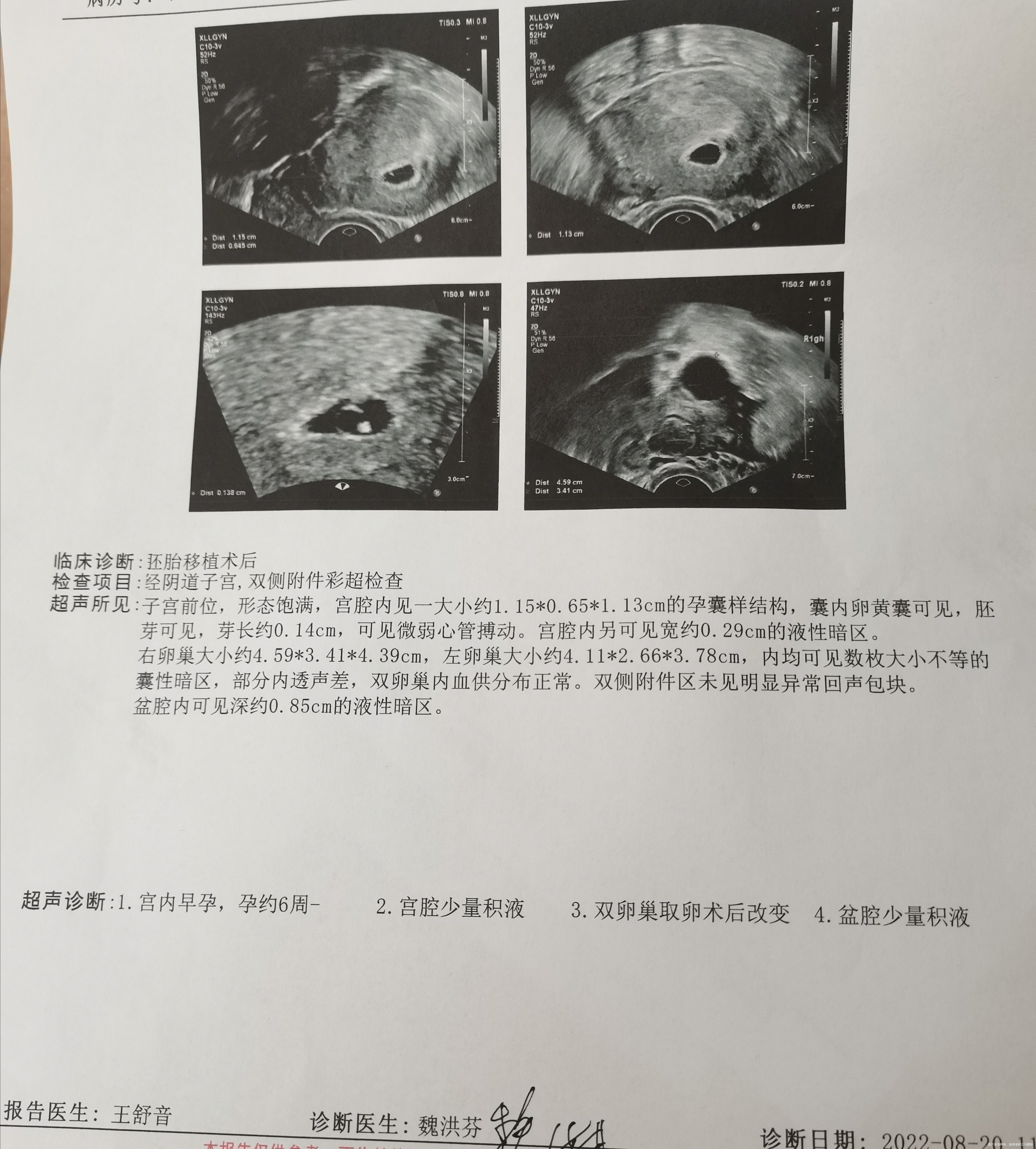 试管移植第22天hcg15250mIU/ml