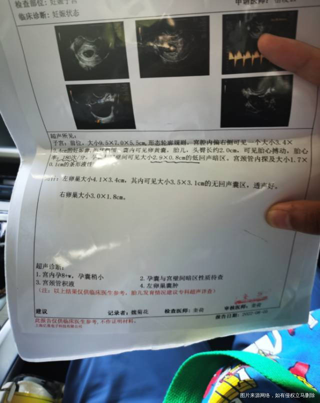 请问医生这个b超显示正常吗现在是孕75天上一