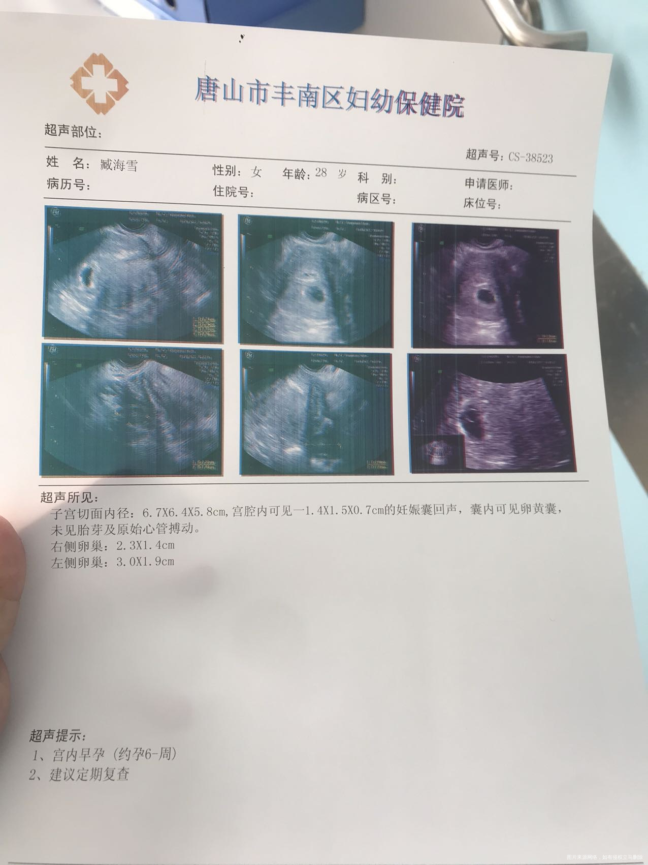 想问一下这个大小的孕囊好排吗